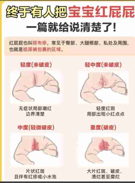 宝宝红屁屁护理技巧-宝宝红屁屁护理技巧视频